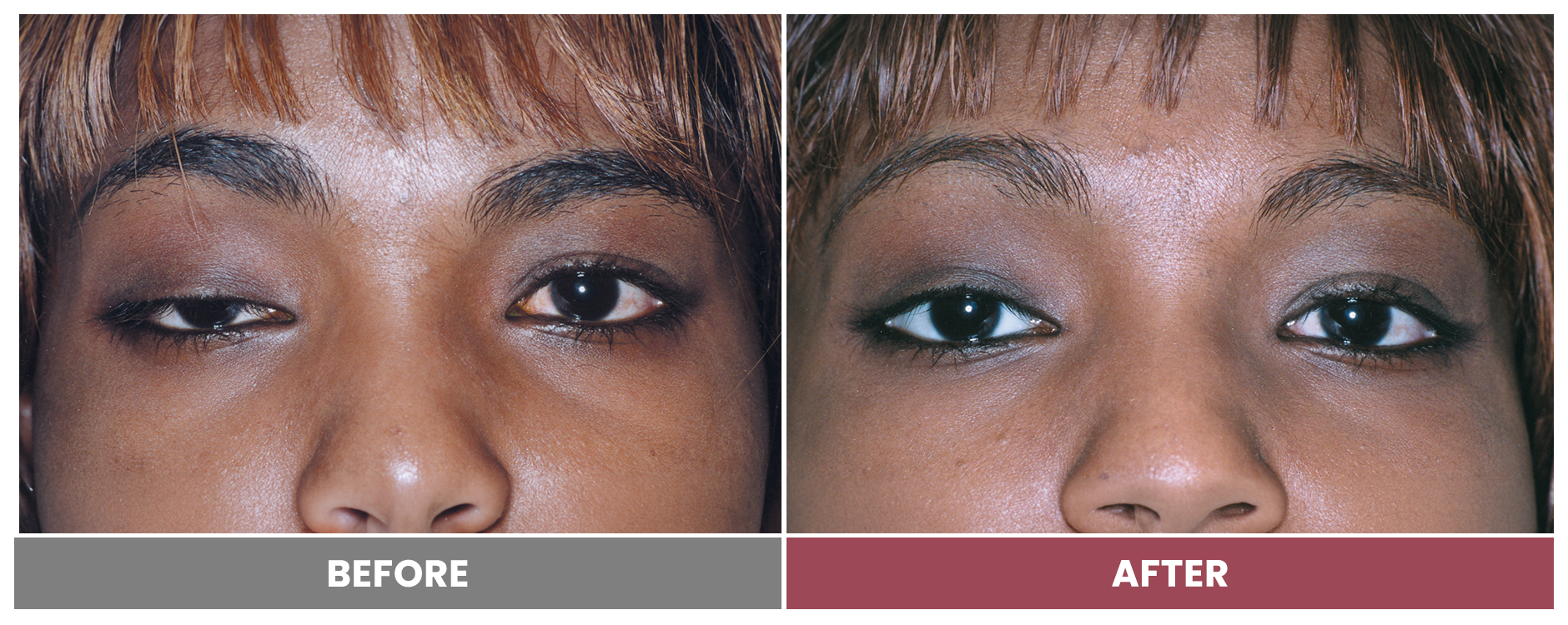 PTOSIS REPAIR - Case 17